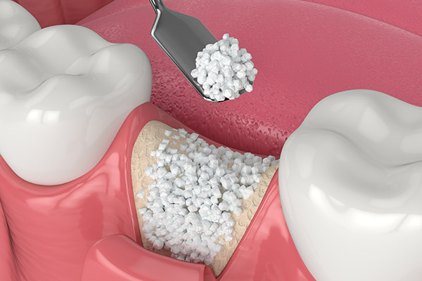 What Is The Process Of Getting Dental Implants?