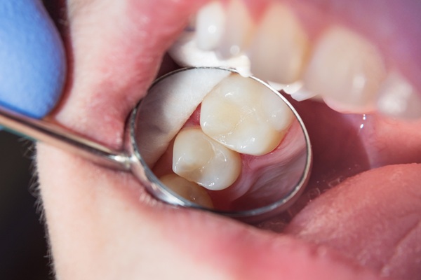 Choosing The Right Tooth Filling For You