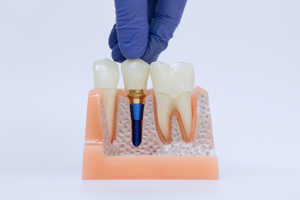 Exploring Your Tooth Replacement Options After Tooth Loss
